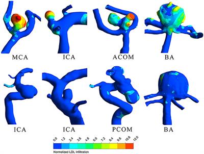 Elevated Lipid Infiltration Is Associated With Cerebral Aneurysm Rupture